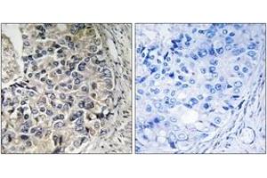 Immunohistochemistry analysis of paraffin-embedded human prostate carcinoma tissue, using CMC1 Antibody. (CMC1 抗体  (AA 391-440))