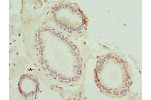 Immunohistochemistry of paraffin-embedded human breast cancer using ABIN7159178 at dilution of 1:100 (MATK 抗体  (AA 393-507))