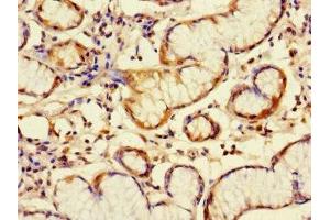 Immunohistochemistry of paraffin-embedded human gastric cancer using ABIN7145670 at dilution of 1:100 (C6orf89 抗体  (AA 120-320))