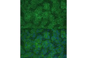 Immunofluorescence analysis of human liver cancer using CBS Rabbit pAb (ABIN3021958, ABIN3021959, ABIN3021960 and ABIN6218521) at dilution of 1:100 (40x lens). (CBS 抗体  (AA 252-551))