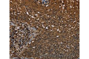 Immunohistochemistry of Human colon cancer using MYBBP1A Polyclonal Antibody at dilution of 1:40 (MYBBP1A 抗体)