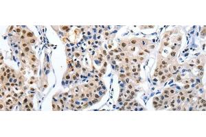 Immunohistochemistry of paraffin-embedded Human lung cancer tissue using MAGEA6 Polyclonal Antibody at dilution 1:120 (MAGEA6 抗体)