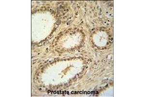 SNRNP40 Antibody (Center) (ABIN651465 and ABIN2840256) immunohistochemistry analysis in formalin fixed and paraffin embedded human prostate carcinoma followed by peroxidase conjugation of the secondary antibody and DAB staining. (SNRNP40 抗体  (AA 122-149))