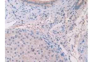 IHC-P analysis of Human Glioma Tissue, with DAB staining. (IL-33 抗体  (AA 112-270))