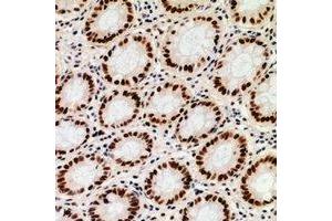 Immunohistochemical analysis of ZNF839 staining in human colon cancer formalin fixed paraffin embedded tissue section. (ZNF839 抗体)