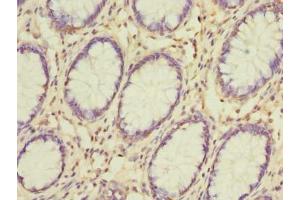 Immunohistochemistry of paraffin-embedded human colon cancer using ABIN7153651 at dilution of 1:100 (Gasdermin B 抗体  (AA 63-310))