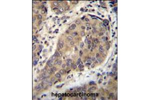 WTIP Antibody immunohistochemistry analysis in formalin fixed and paraffin embedded human hepatocarcinoma followed by peroxidase conjugation of the secondary antibody and DAB staining. (WTIP 抗体  (AA 243-271))