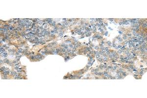 Immunohistochemistry of paraffin-embedded Human thyroid cancer using SERPINB11 Polyclonal Antibody at dilution of 1/20 (SERPINB11 抗体)