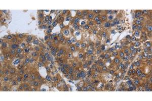 Immunohistochemistry of paraffin-embedded Human liver cancer using SOCS1 Polyclonal Antibody at dilution of 1:90 (SOCS1 抗体)