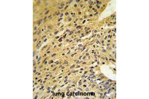 COQ5 Antibody (Center) IHC analysis in formalin fixed and paraffin embedded human lung carcinoma followed by peroxidase conjugation of the secondary antibody and DAB staining. (COQ5 抗体  (Middle Region))