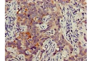 Immunohistochemistry of paraffin-embedded human pancreatic cancer using ABIN7165664 at dilution of 1:100 (JAG1 抗体  (AA 809-1046))
