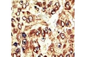 IHC analysis of FFPE human hepatocarcinoma tissue stained with the WEE1 antibody (WEE1 抗体  (AA 604-634))