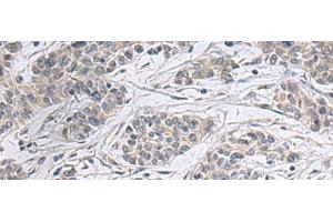 Immunohistochemistry of paraffin-embedded Human colorectal cancer tissue using PPM1K Polyclonal Antibody at dilution of 1:55(x200) (PPM1K 抗体)