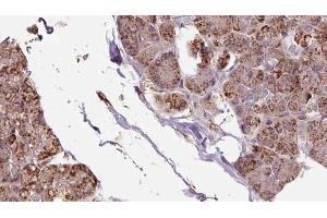 ABIN6273281 at 1/100 staining Human pancreas cancer tissue by IHC-P. (OXA1L 抗体  (C-Term))