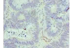 Immunohistochemistry of paraffin-embedded human colon cancer using ABIN7143847 at dilution of 1:100 (ACTR1A 抗体  (AA 187-376))