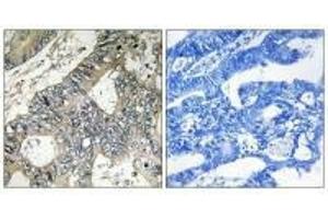 Immunohistochemistry analysis of paraffin-embedded human colon carcinoma tissue using GUF1 antibody.