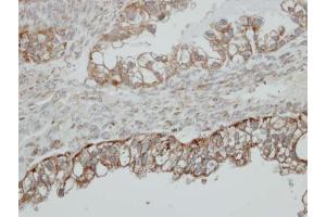 IHC-P Image Immunohistochemical analysis of paraffin-embedded human ovarian cancer, using HSD17B4, antibody at 1:500 dilution. (HSD17B4 抗体  (N-Term))