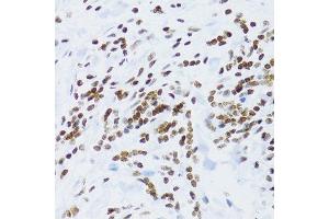 Immunohistochemistry of paraffin-embedded human gastric cancer using NFKB2 Antibody. (NFKB2 抗体  (AA 690-899))