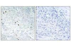 Immunohistochemistry analysis of paraffin-embedded human breast carcinoma tissue, using TP53INP2 antibody.