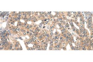 Immunohistochemistry of paraffin-embedded Human liver cancer tissue using GPR55 Polyclonal Antibody at dilution of 1:40(x200) (GPR55 抗体)