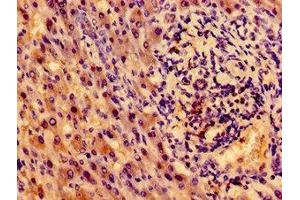 Immunohistochemistry of paraffin-embedded human liver cancer using ABIN7155192 at dilution of 1:100 (TRKA 抗体  (AA 33-208))
