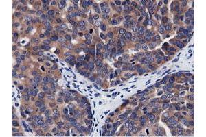 Immunohistochemical staining of paraffin-embedded Adenocarcinoma of Human breast tissue using anti-CBWD1 mouse monoclonal antibody. (CBWD1 抗体)