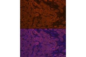 Immunofluorescence analysis of human liver cancer using ApoM Rabbit mAb (ABIN7265646) at dilution of 1:100 (40x lens). (Apolipoprotein M 抗体)