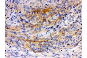 Anti-GAP43 antibody, IHC(P) IHC(P): Human Meningeoma Tissue (GAP43 抗体  (C-Term))