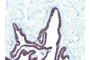 Formalin-fixed, paraffin-embedded human ovarian carcinoma stained with Cytokeratin 8 + 18 antibody (KRT8/803 + KRT18/835). (Cytokeratin 8/18 抗体)