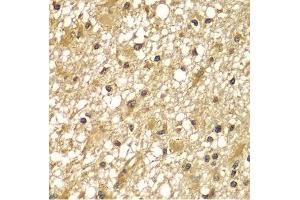 Immunohistochemistry of paraffin-embedded human brain cancer using PIK3R3 antibody (ABIN5975675) at dilution of 1/100 (40x lens). (PIK3R3 抗体)