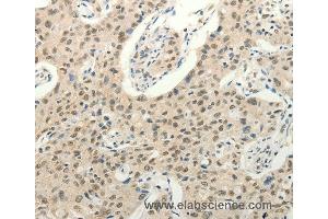 Immunohistochemistry of Human ovarian cancer using FZD10 Polyclonal Antibody at dilution of 1:50 (FZD10 抗体)