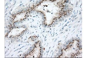 Immunohistochemical staining of paraffin-embedded Adenocarcinoma of Human colon tissue using anti-HSPA1A mouse monoclonal antibody. (HSP70 1A 抗体)