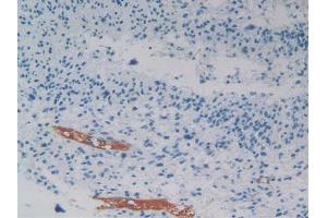 IHC-P analysis of Human Glioma Tissue, with DAB staining. (PEDF 抗体  (AA 21-415))