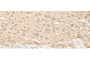 Immunohistochemistry of paraffin-embedded Human esophagus cancer tissue using IMPA1 Polyclonal Antibody at dilution of 1:25(x200) (IMPA1 抗体)