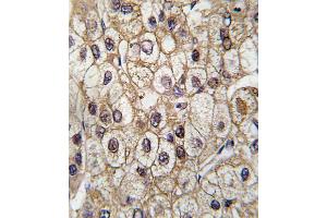 Formalin-fixed and paraffin-embedded human hepatocarcinoma tissue reacted with CYP2C9 antibody , which was peroxidase-conjugated to the secondary antibody, followed by DAB staining. (CYP2C9 抗体  (AA 235-265))