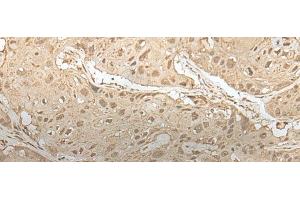 Immunohistochemistry of paraffin-embedded Human esophagus cancer tissue using ZBTB18 Polyclonal Antibody at dilution of 1:50(x200) (ZNF238 抗体)