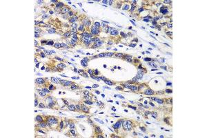 Immunohistochemistry of paraffin-embedded human gastric cancer using RPN1 antibody at dilution of 1:100 (x40 lens). (RPN1 抗体)