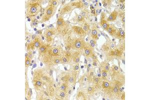 Immunohistochemistry of paraffin-embedded human liver injury using EIF4G1 Antibody (ABIN5975844) at dilution of 1/100 (40x lens). (EIF4G1 抗体)