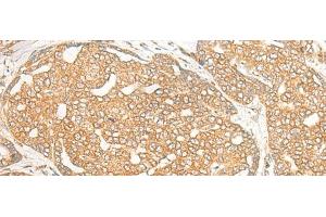 Immunohistochemistry of paraffin-embedded Human liver cancer tissue using DOC2B Polyclonal Antibody at dilution of 1:25(x200) (DOC2B 抗体)
