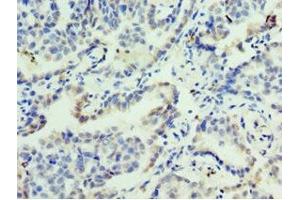 Immunohistochemistry of paraffin-embedded human lung cancer using ABIN7153128 at dilution of 1:100 (FOSL2 抗体  (AA 187-326))
