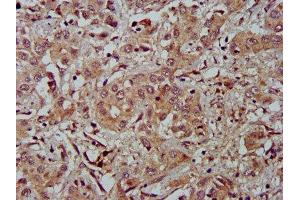 IHC image of ABIN7152919 diluted at 1:500 and staining in paraffin-embedded human liver cancer performed on a Leica BondTM system. (FBLN2 抗体  (AA 301-440))