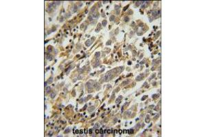 ASB17 Antibody immunohistochemistry analysis in formalin fixed and paraffin embedded human testis carcinoma followed by peroxidase conjugation of the secondary antibody and DAB staining.