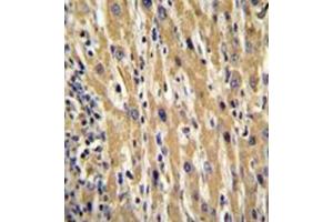 Immunohistochemistry analysis in formalin fixed and paraffin embedded human hepatocarcinoma reacted with Galanin Antibody (Center) followed by peroxidase conjugation of the secondary antibody and DAB staining. (Galanin 抗体  (Middle Region))
