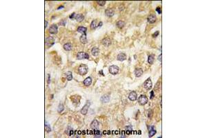 Formalin-fixed and paraffin-embedded human prostata carcinoma tissue reacted with MAP2K2 Antibody (T394) , which was peroxidase-conjugated to the secondary antibody, followed by DAB staining. (MEK2 抗体  (AA 372-400))