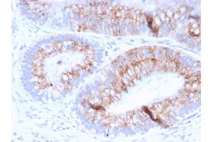 Formalin-fixed, paraffin-embedded human Colon Carcinoma stained with MUC2 Mouse Monoclonal Antibody (MLP/842). (MUC2 抗体)