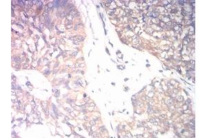 Immunohistochemical analysis of paraffin-embedded bladder cancer tissues using CD131 mouse mAb with DAB staining. (CD131 抗体  (AA 17-149))