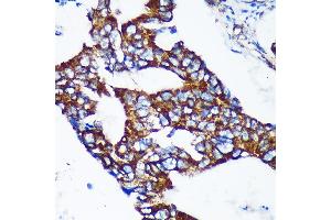 Immunohistochemistry of paraffin-embedded Human colon carcinoma using EPN2 Rabbit pAb (ABIN7267002) at dilution of 1:100 (40x lens). (Epsin 2 抗体  (AA 120-300))