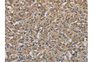 The image on the left is immunohistochemistry of paraffin-embedded Human thyroid cancer tissue using ABIN7128303(AGTRAP Antibody) at dilution 1/40, on the right is treated with fusion protein. (AGTRAP 抗体)