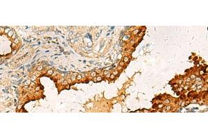 Immunohistochemistry of paraffin-embedded Human prost ate cancer tissue using PDCL Polyclonal Antibody at dilution of 1:40(x200) (Phosducin-Like 抗体)