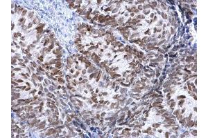 IHC-P Image FOXA1 antibody detects FOXA1 protein at nucleus on human cervical carcinoma by immunohistochemical analysis. (FOXA1 抗体  (C-Term))